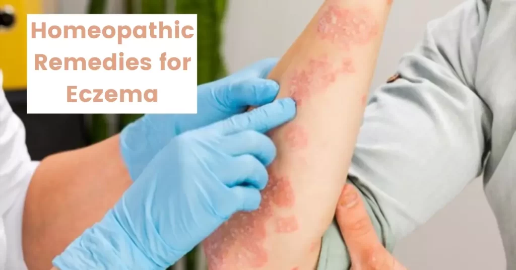 Homeopathic Remedies for Eczema – Causes & Best Medicines