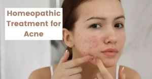 Homeopathy For Acne – Causes, Symptoms & Best Medicines