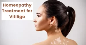 Homeopathy for Vitiligo – Causes, Symptoms & Best Medicines