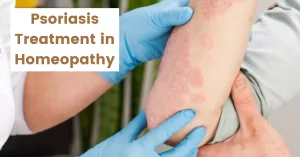 Psoriasis Treatment in Homeopathy – Causes & 12 Best Remedy