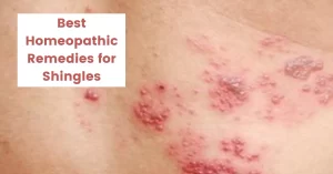 Homeopathy for Shingles –  Symptoms, Causes & Best 10 Remedies