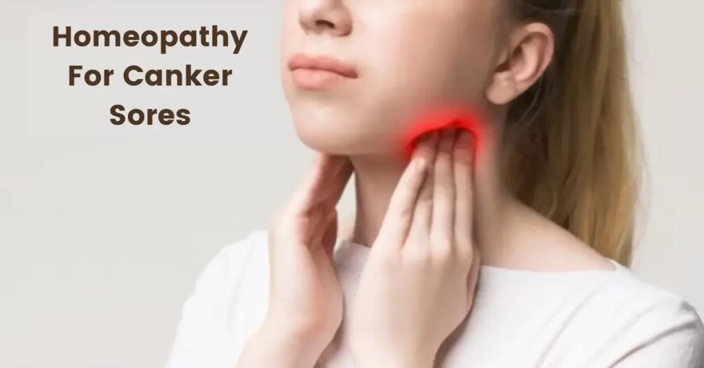 Homeopathy for Canker Sores – Causes & Best 10 Medicines