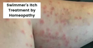 Swimmer’s Itch Treatment – 12 Best Homeopathic Medicines