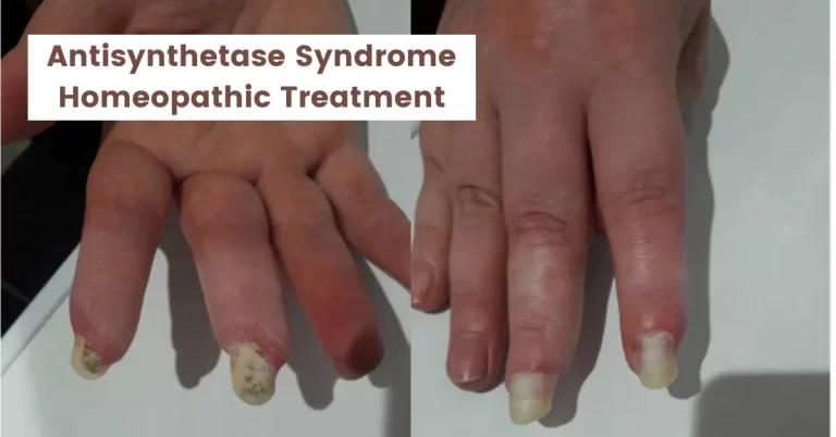 Antisynthetase Syndrome – Symptoms & Homeopathic Treatment