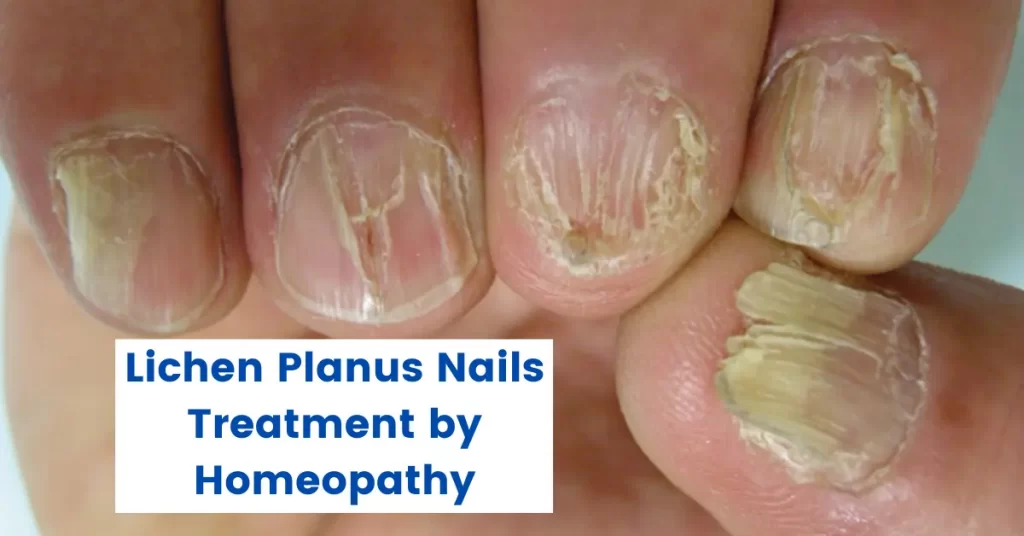 Lichen Planus Nails – 10 Best Homeopathic Treatment