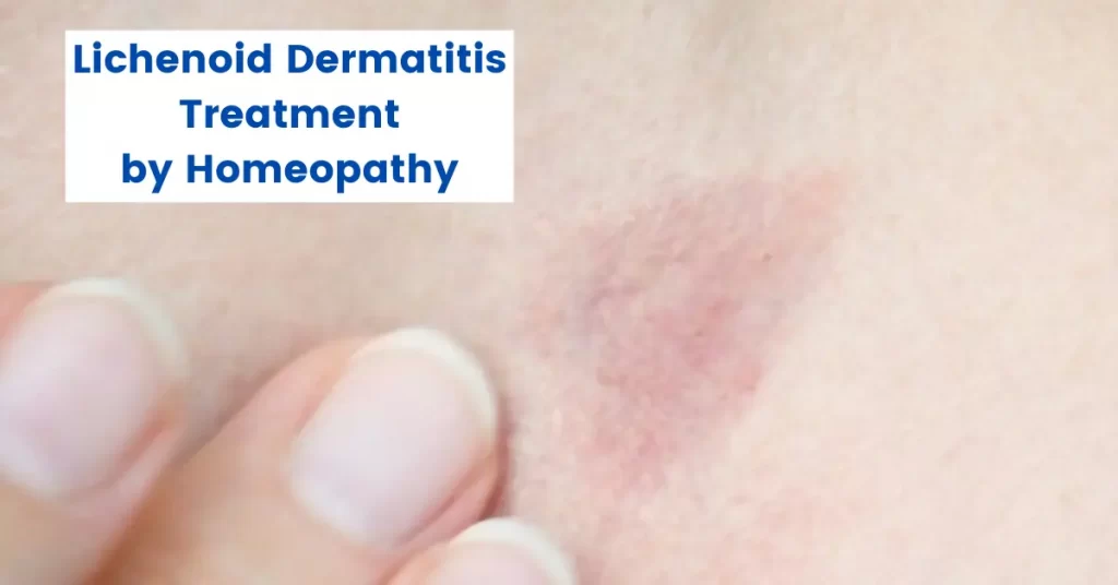 Lichenoid Dermatitis Treatment – Best Homeopathic Medicines