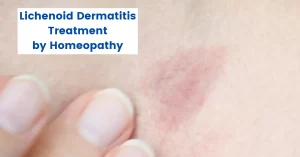 Lichenoid Dermatitis Treatment – Best Homeopathic Medicines