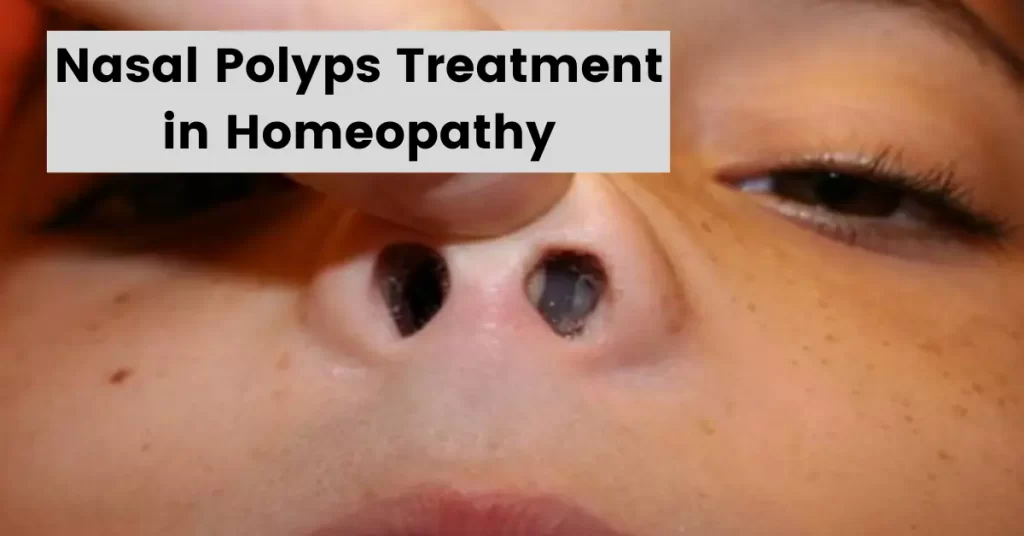 Homeopathic Medicine for Nasal Polyps