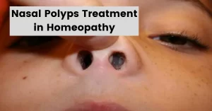 10 Best Homeopathic Medicine for Nasal Polyps