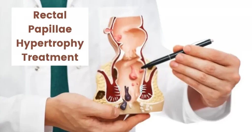 Rectal Papillae Hypertrophy - Treatment in Homeopathy