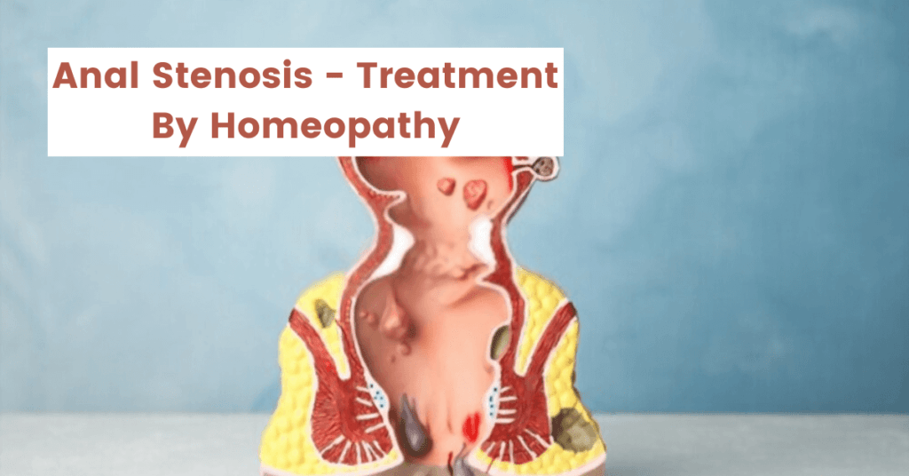 Anal Stenosis - Symptoms, Causes and 10 Homeopathic Medicines