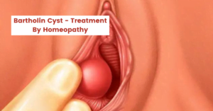 Bartholin Cyst – Treatment & Best 17 Homeopathic Medicines