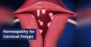 Cervical Polyps – Symptoms, Causes & Homeopathic Remedies