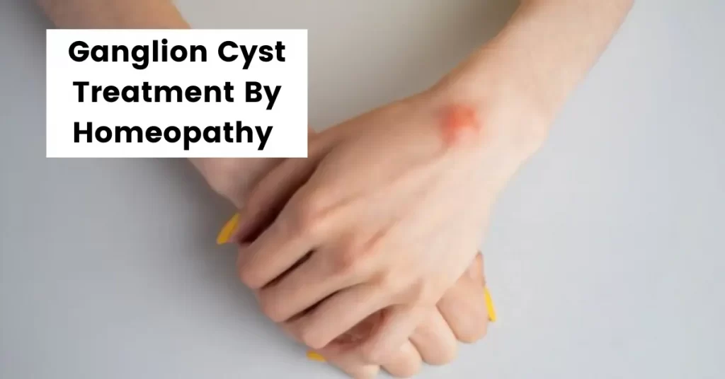 Ganglion Cyst Wrist, Foot, Finger - Treatment By Homeopathy