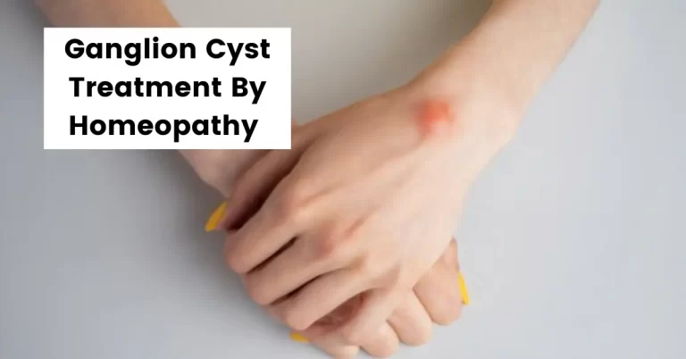 Ganglion Cyst Wrist, Foot, Finger – Treatment By Homeopathy