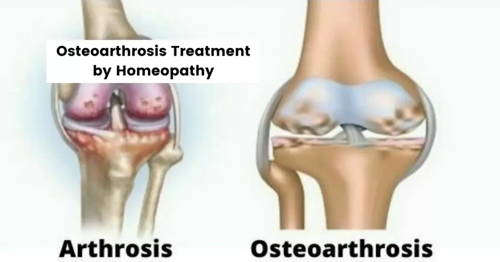 Osteoarthrosis - Symptoms, Causes and Treatment By Homeopathy