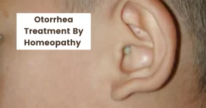 Otorrhea – Definition, Causes & Homeopathic Treatment
