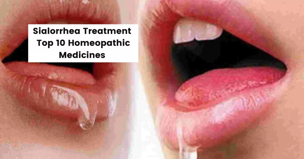 Sialorrhea - Symptoms, Causes and Top 10 Homeopathic Medicines