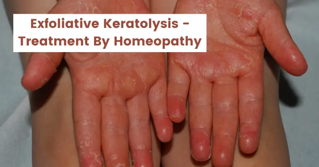 Exfoliative Keratolysis- Causes and Best Homeopathic Treatment
