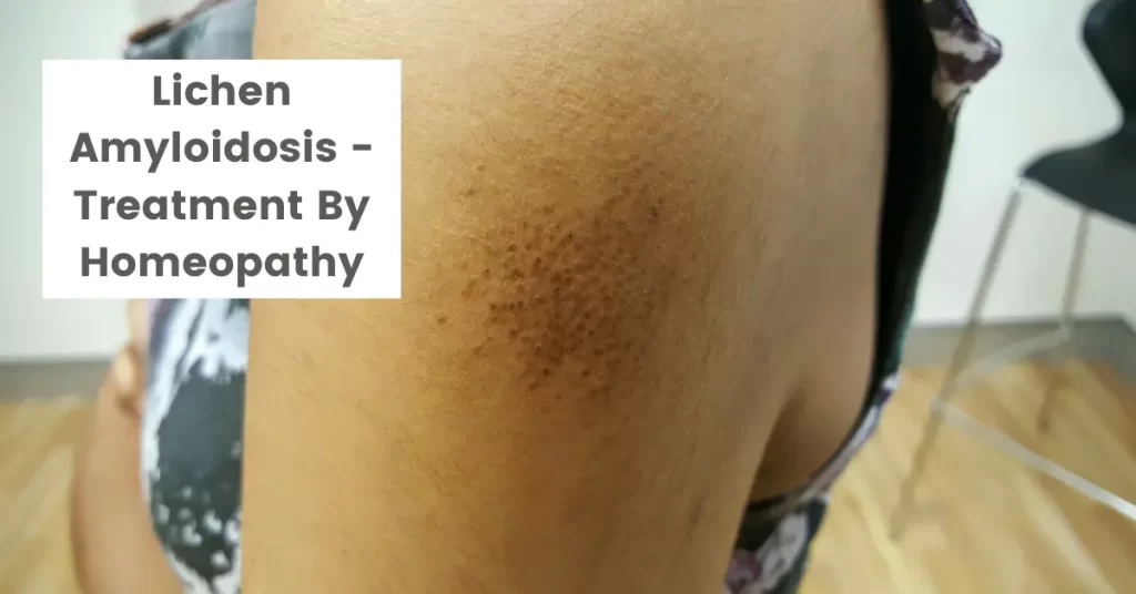Lichen Amyloidosis - Causes and Top 10 Homeopathic Medicines