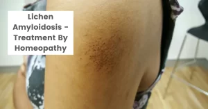 Lichen Amyloidosis – Causes & Top 10 Homeopathic Medicines