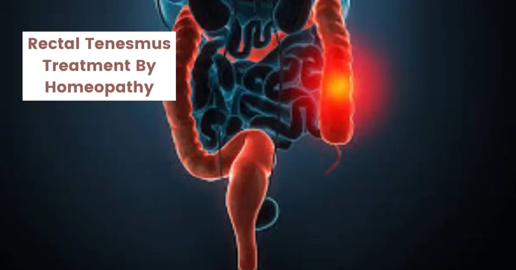 Rectal Tenesmus – Causes & Best Treatment by Homeopathy
