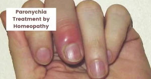 Paronychia Treatment – Causes & Top 10 Homeopathic Medicines