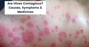 Are Hives Contagious? Causes & Best 10 Homeopathy Medicines