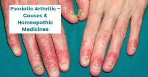 Psoriatic Arthritis – Causes & 13 Best Homeopathic Medicines