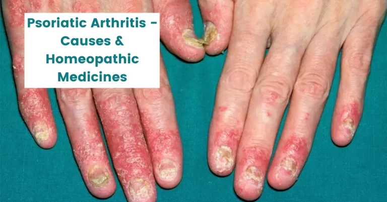 Psoriatic Arthritis – Causes & 13 Best Homeopathic Medicines
