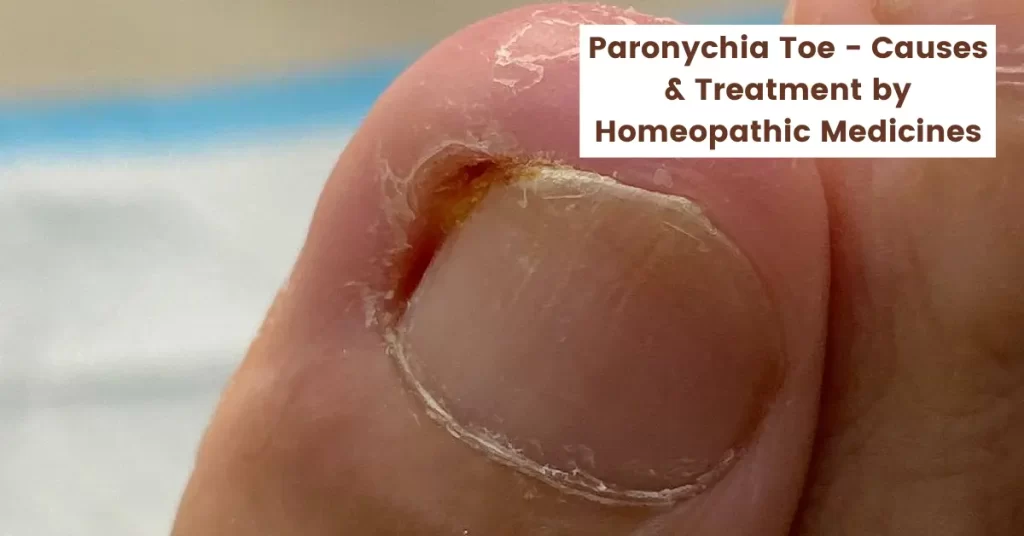 Paronychia Toe Paronychia Healing Stages - with Homeopathy