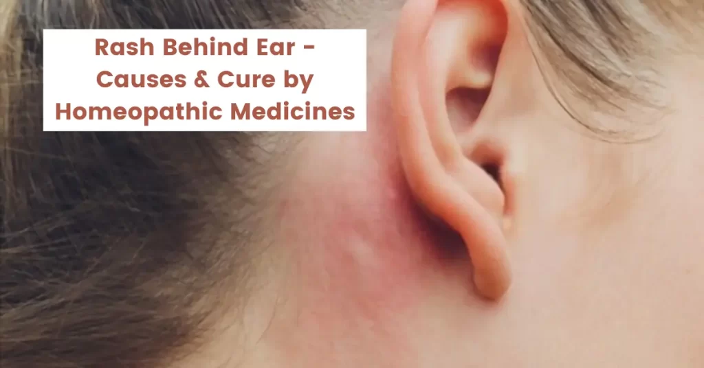 Rash Behind Ear - Causes and Treatment by Homeopathy Medicines