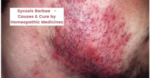 Sycosis Barbae – Causes, Symptom, Best Homeopathic Medicine
