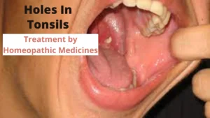 Holes In Tonsils – Symptoms, Causes & Homeopathy Treatment