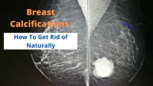 How To Get Rid of Breast Calcifications Naturally Homeopathy