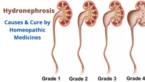 Hydronephrosis – Causes & Best Homeopathic Medicines