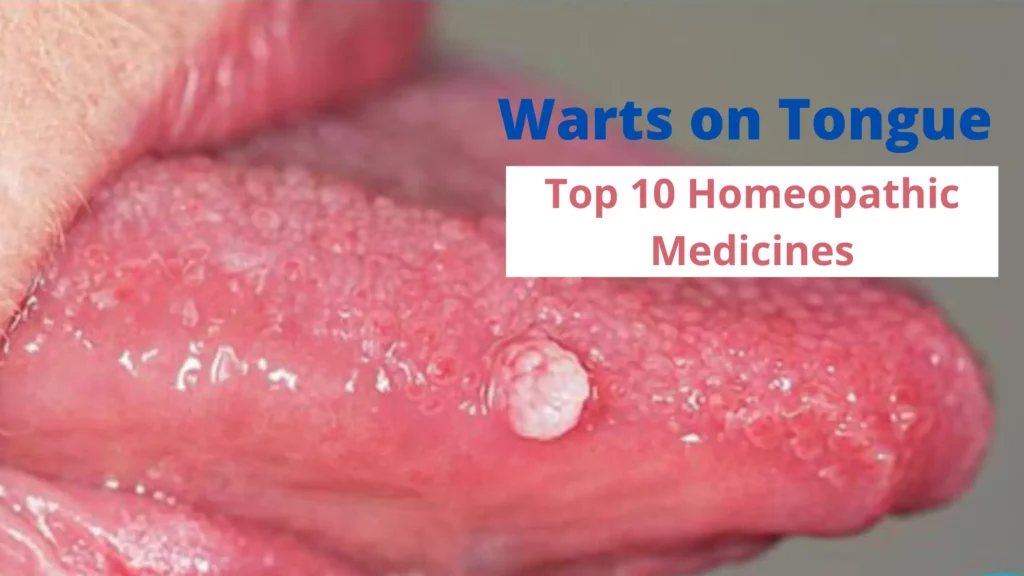 Warts on Tongue – Causes & Best 10 Homeopathic Medicines