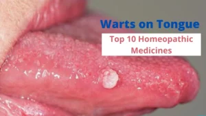 Warts on Tongue – Causes & Best 10 Homeopathic Medicines