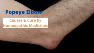 Popeye Elbow – Causes & Best Homeopathic Medicines