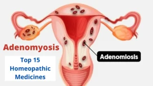 Top 15 Homeopathic Medicines for Adenomyosis