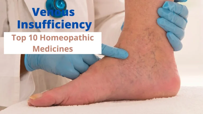 Venous Insufficiency – Causes & Best Homeopathic Medicines
