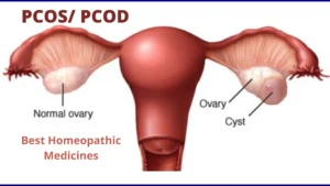 PCOS/ PCOD – Causes, Symptoms & Homeopathy Treatment