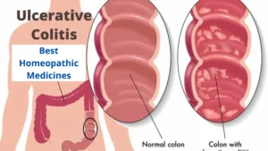 Ulcerative Colitis and its Best Homeopathic Treatment