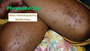 Phrynoderma- Symptoms, Causes & Best Homoeopathic Treatment