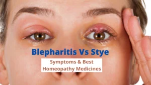 Blepharitis Vs Stye – Symptoms & Best Homeopathic Medicines