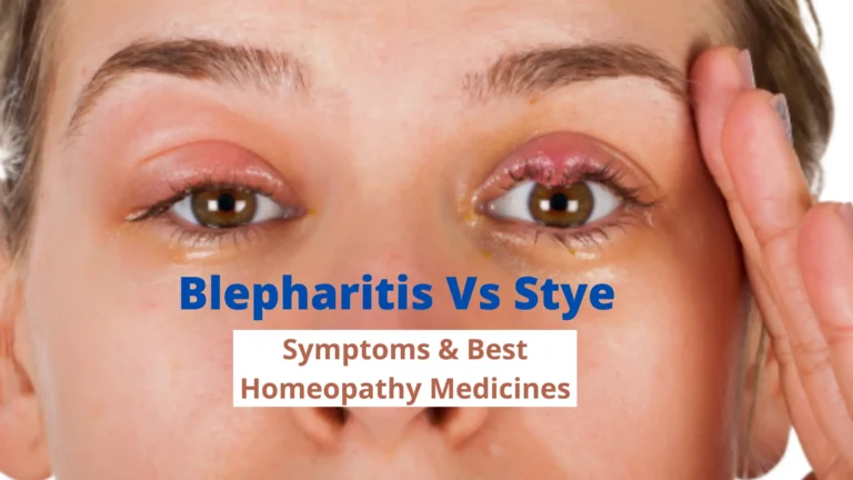 Blepharitis Vs Stye – Symptoms & Best Homeopathic Medicines