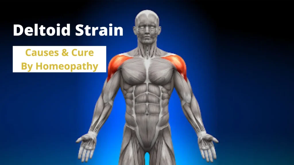 Deltoid Strain - Causes and Cure by Best Homeopathic Medicines