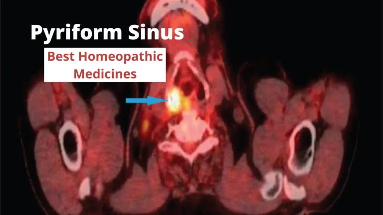 Pyriform Sinus – Causes, Symptoms & Best Homeopathic Medicines