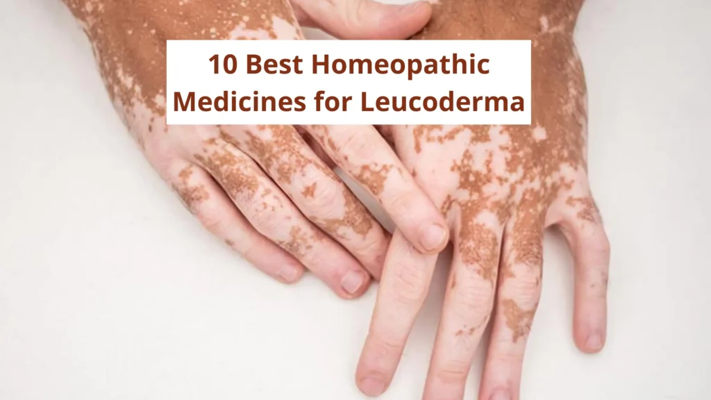 10 Best Homeopathic Medicine for Leucoderma