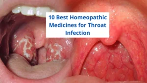 10 Best Homeopathic Medicine for Throat Infection